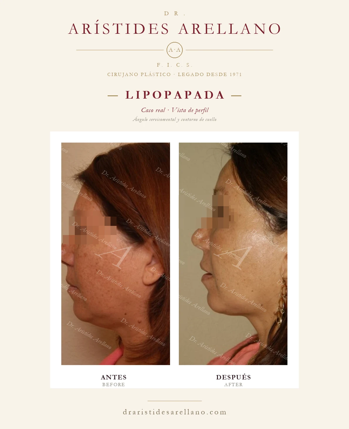 Submental liposuction in Puebla — profile view — cervicomental angle and neck contour, before and after by Dr. Arístides Arellano