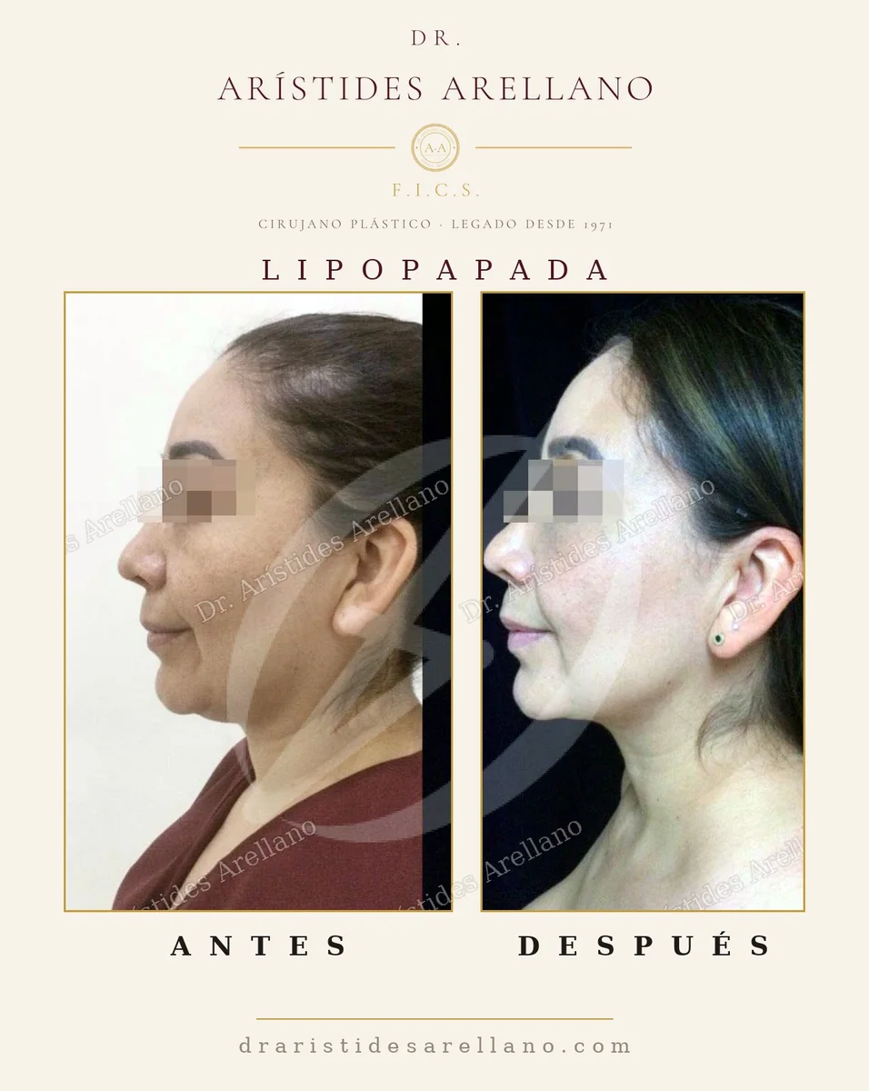 Lipopapada (submental liposuction) — before and after, chin definition by Dr. Arístides Arellano in Puebla