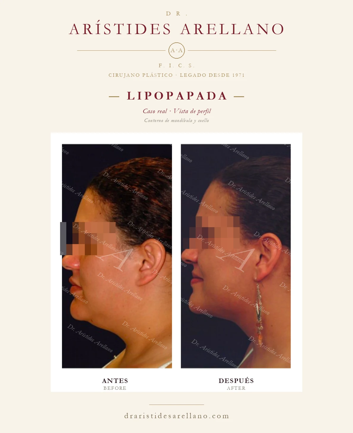 Submental liposuction in Puebla — profile view — jawline and neck contour, before and after by Dr. Arístides Arellano