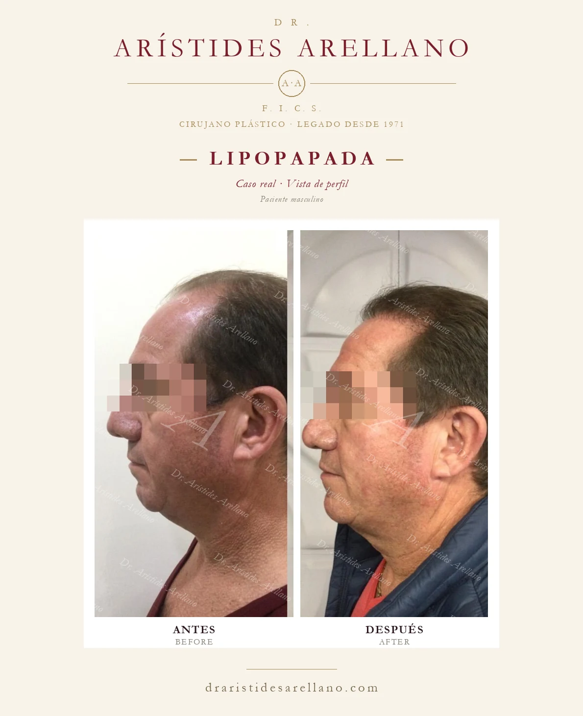Submental liposuction in Puebla — male patient, profile view, before and after by Dr. Arístides Arellano