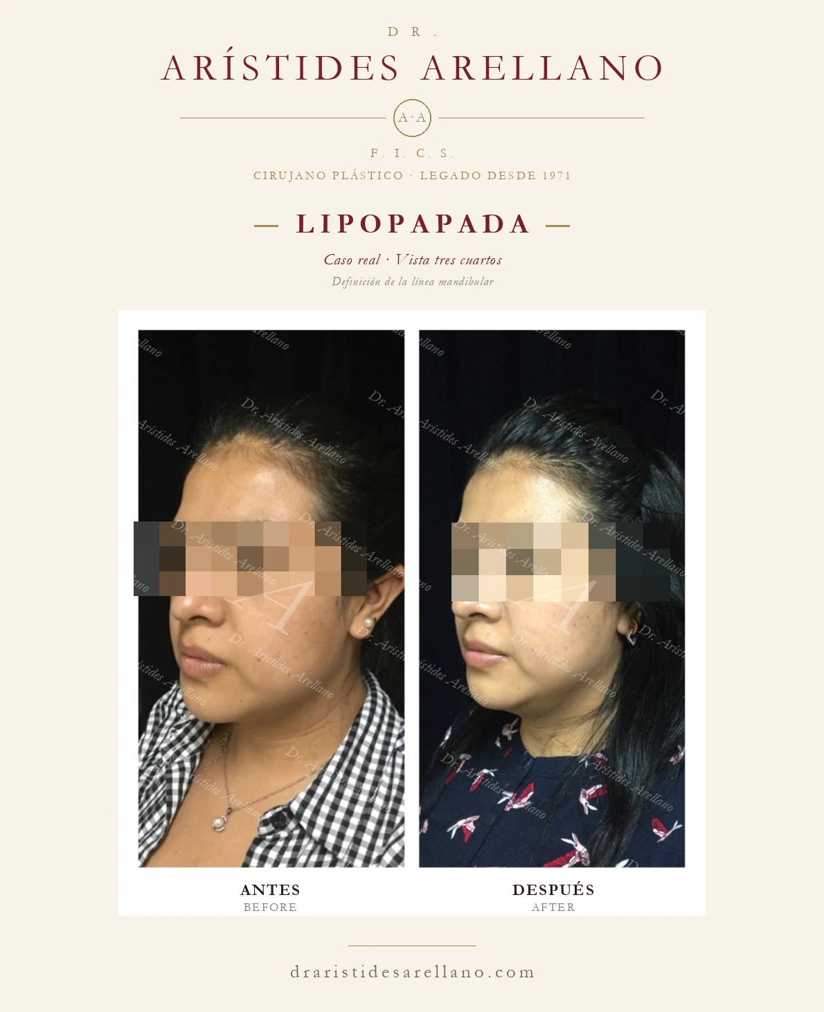 Submental liposuction in Puebla — three-quarter view — jawline definition, before and after by Dr. Arístides Arellano