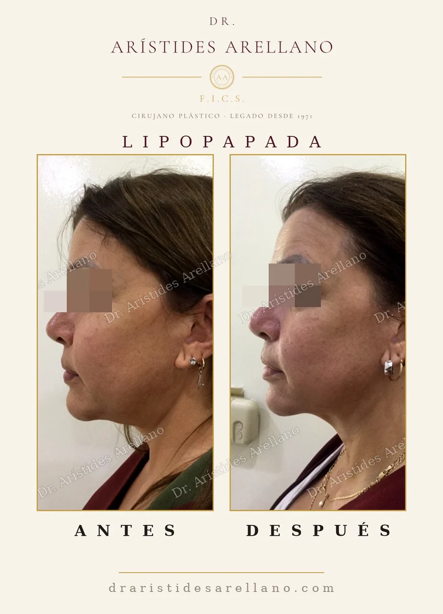 Submental liposuction before and after, double chin removal and neck angle definition, surgery by Dr. Arístides Arellano, plastic surgeon in Puebla