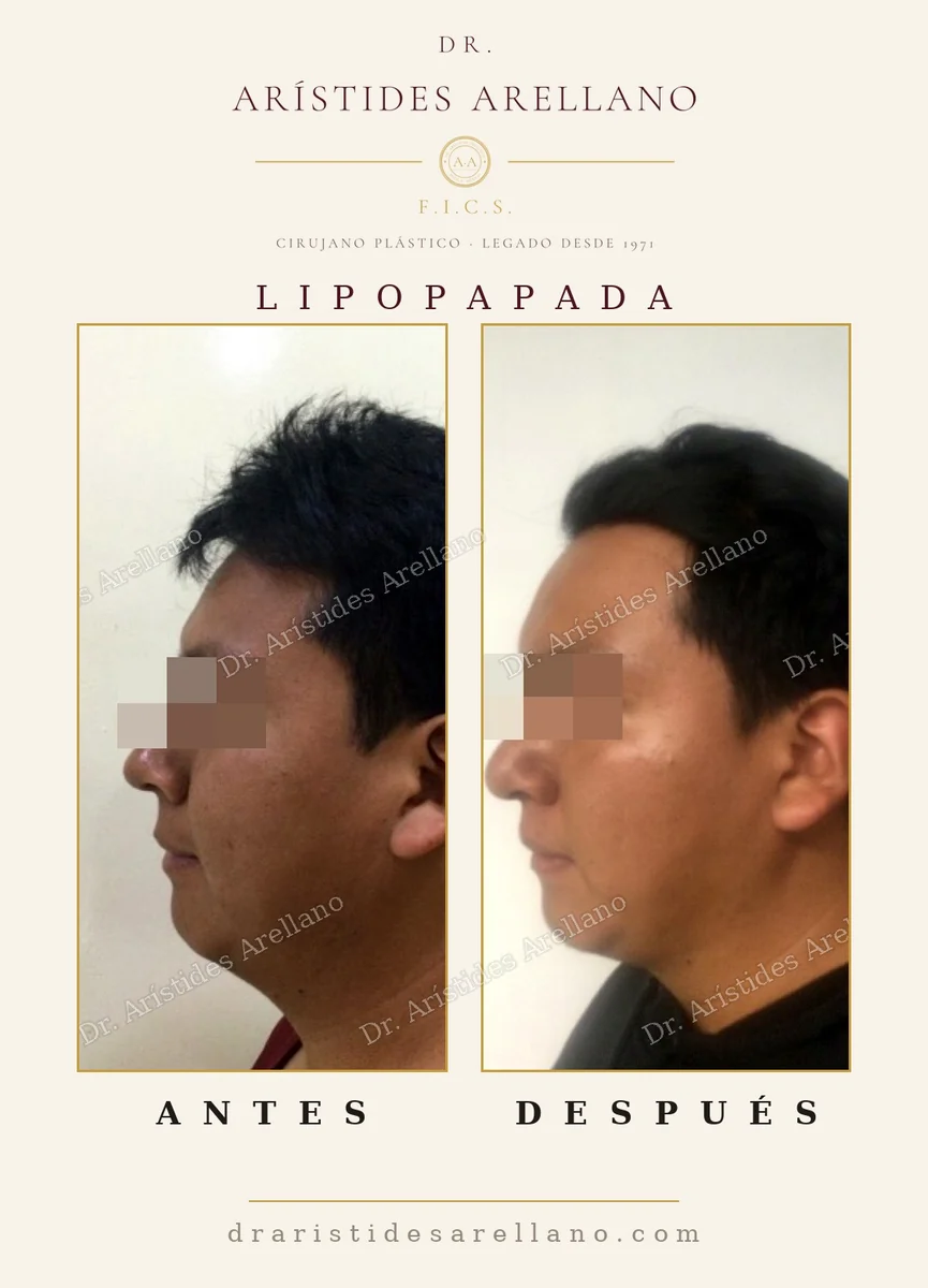 Submental liposuction before and after in profile, double chin in a slim patient, real result by Dr. Arístides Arellano in Puebla