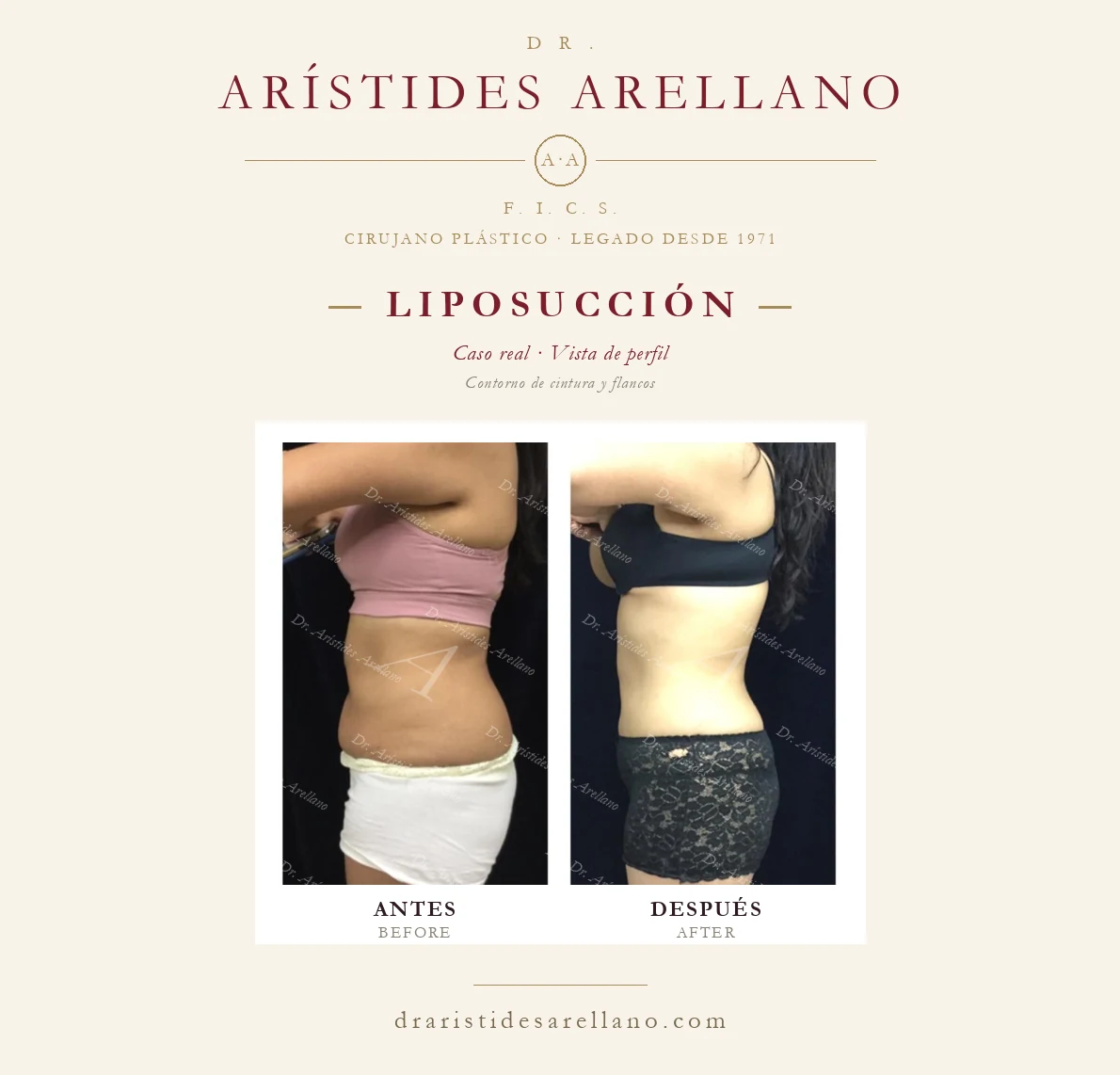 Liposucción de abdomen y cintura — antes y después de perfil, caso real del Dr. Arístides Arellano en Puebla