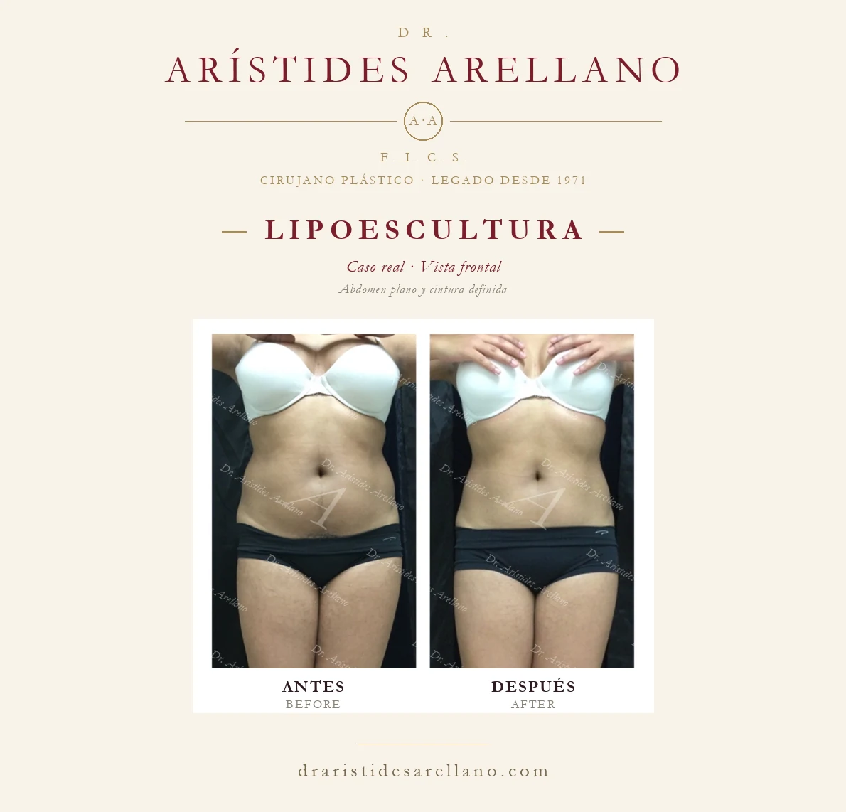 Lipoescultura de abdomen y cintura — antes y después de frente, caso real del Dr. Arístides Arellano en Puebla
