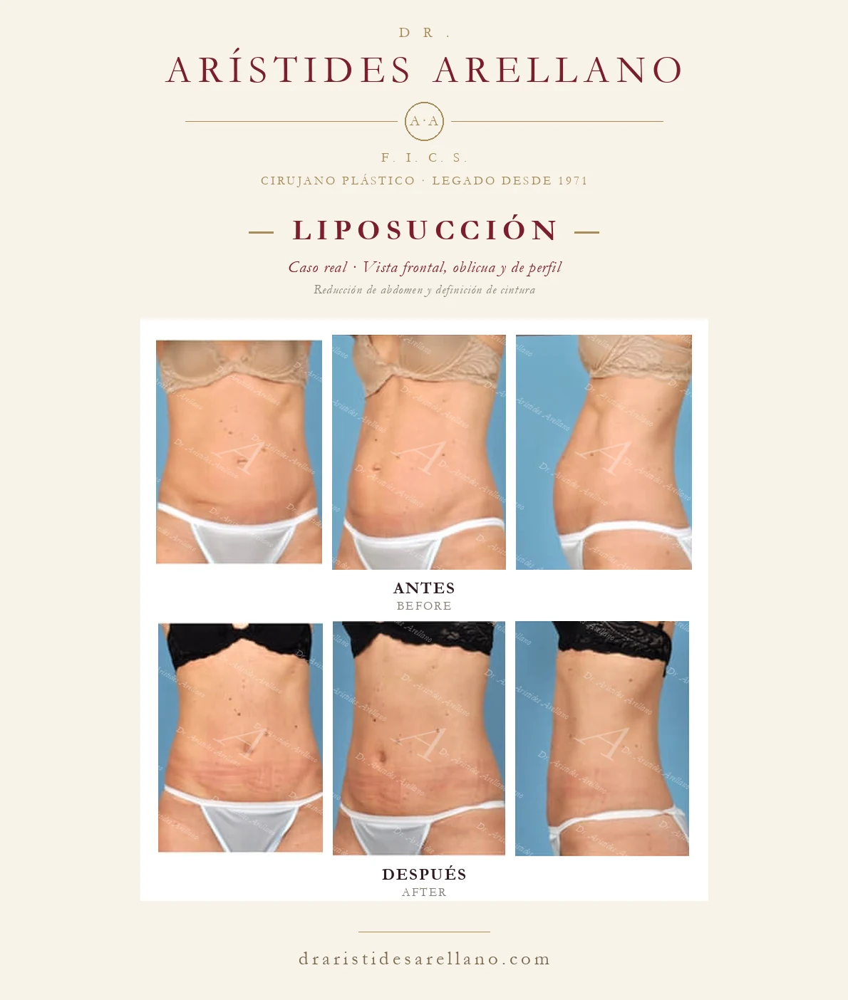 Liposucción de abdomen, cintura y flancos — antes y después en vistas frontal, oblicua y de perfil, caso real del Dr. Arístides Arellano en Puebla