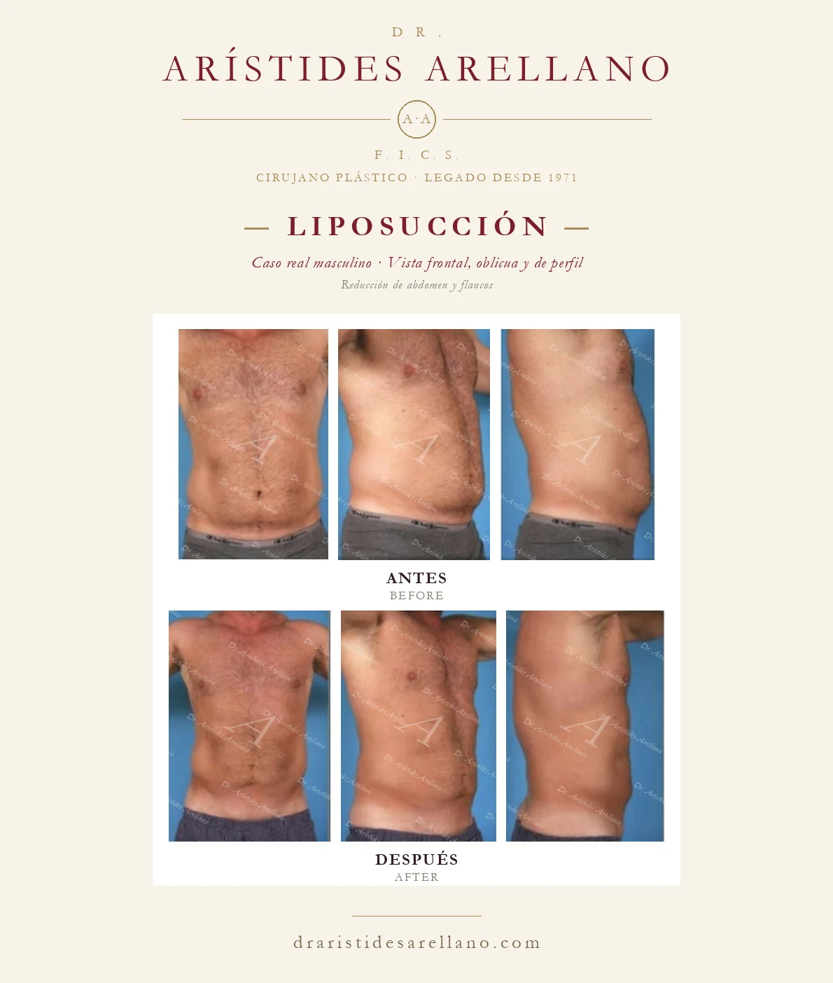 Liposucción de abdomen y flancos en hombre — antes y después en vistas frontal, oblicua y de perfil, caso real del Dr. Arístides Arellano en Puebla