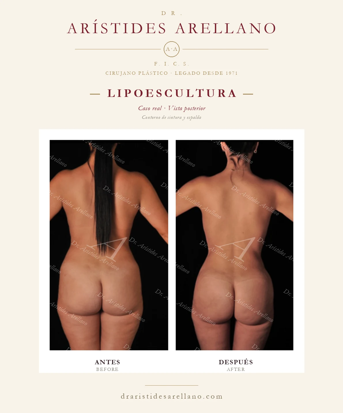 Lipoescultura de cintura y espalda — antes y después vista posterior, caso real del Dr. Arístides Arellano en Puebla