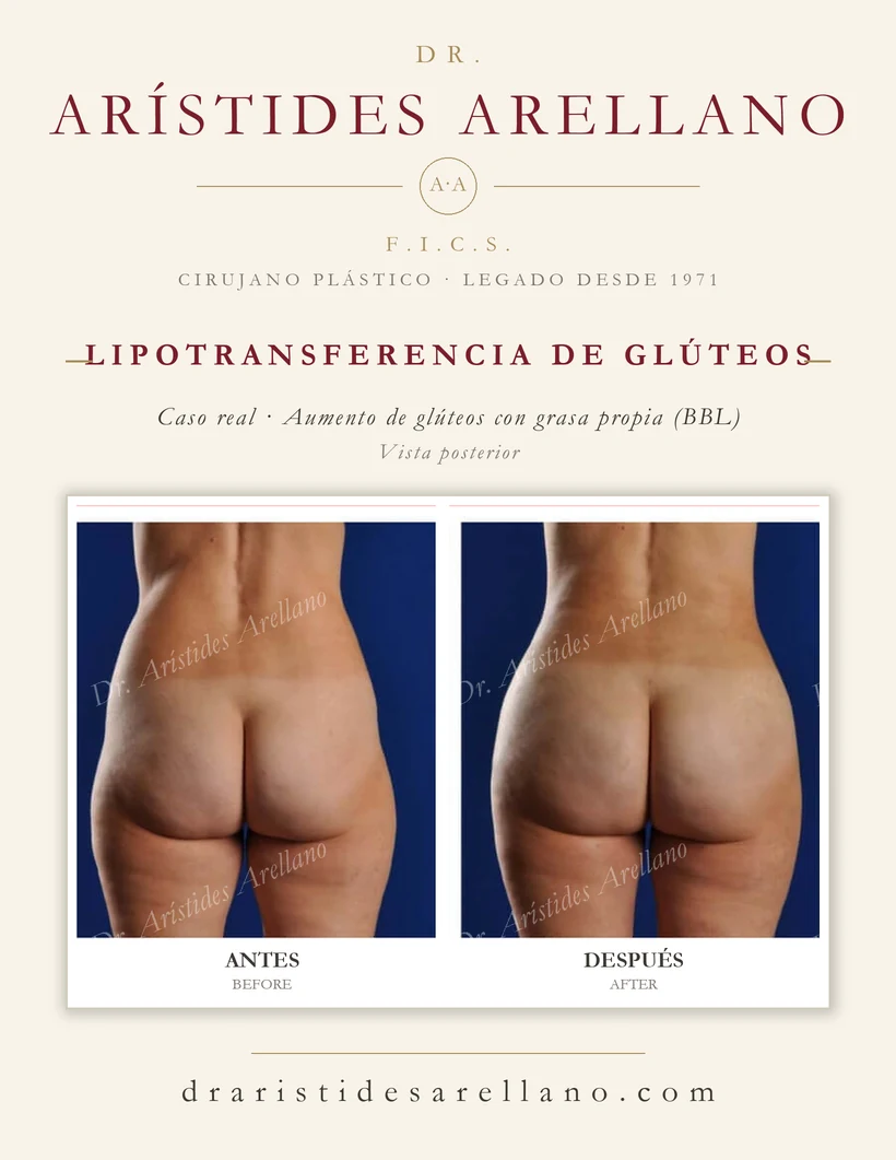 Gluteal fat transfer (buttock augmentation with own fat, BBL) — before and after, posterior view, real case by Dr. Arístides Arellano in Puebla