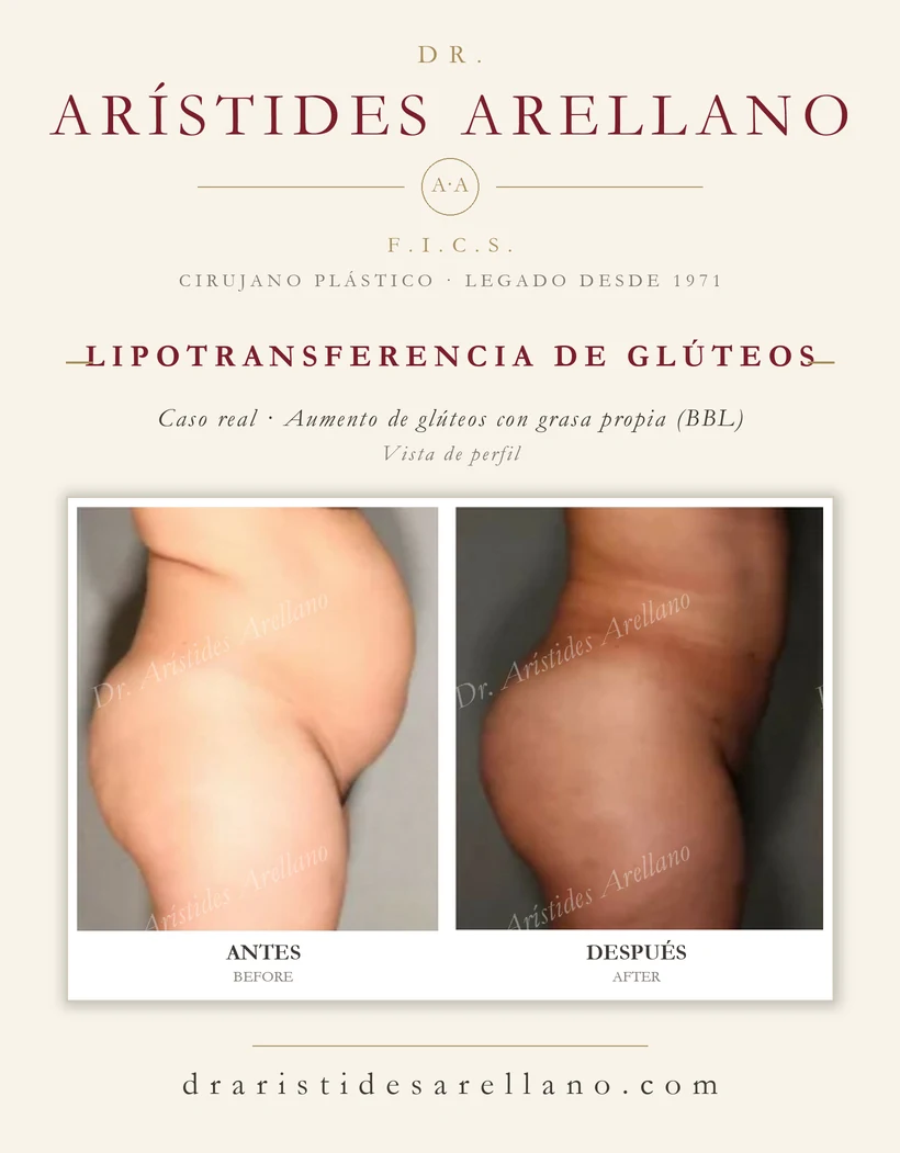 Gluteal fat transfer (buttock augmentation with own fat, BBL) — before and after, profile view, real case by Dr. Arístides Arellano in Puebla