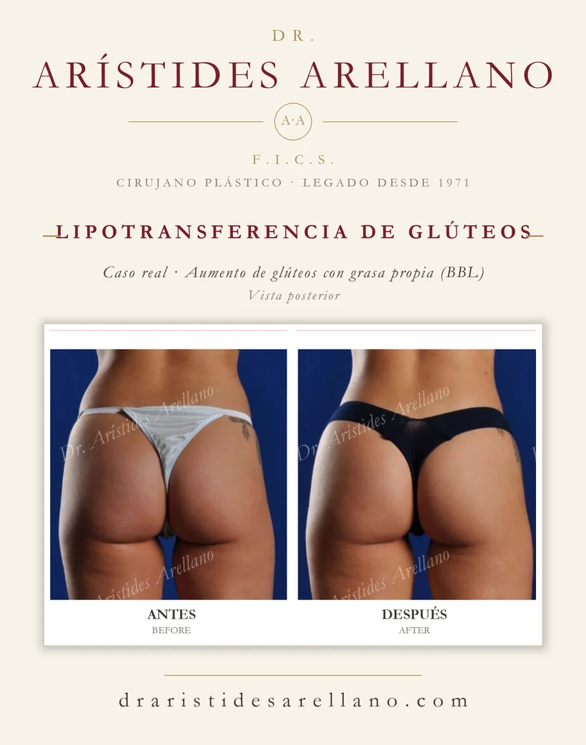 Gluteal fat transfer (buttock augmentation with own fat, BBL) — before and after, posterior view, real case by Dr. Arístides Arellano in Puebla