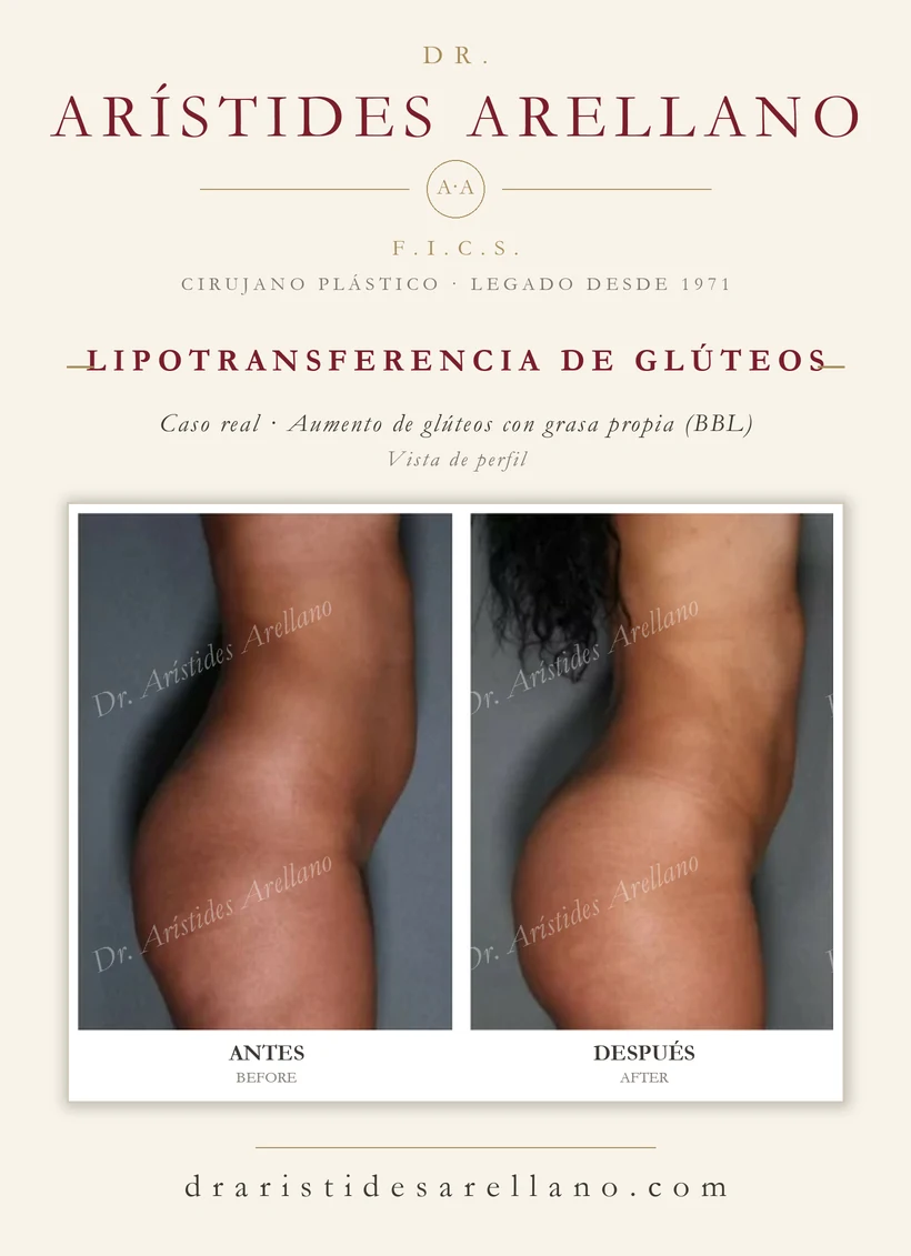 Gluteal fat transfer (buttock augmentation with own fat, BBL) — before and after, profile view, real case by Dr. Arístides Arellano in Puebla