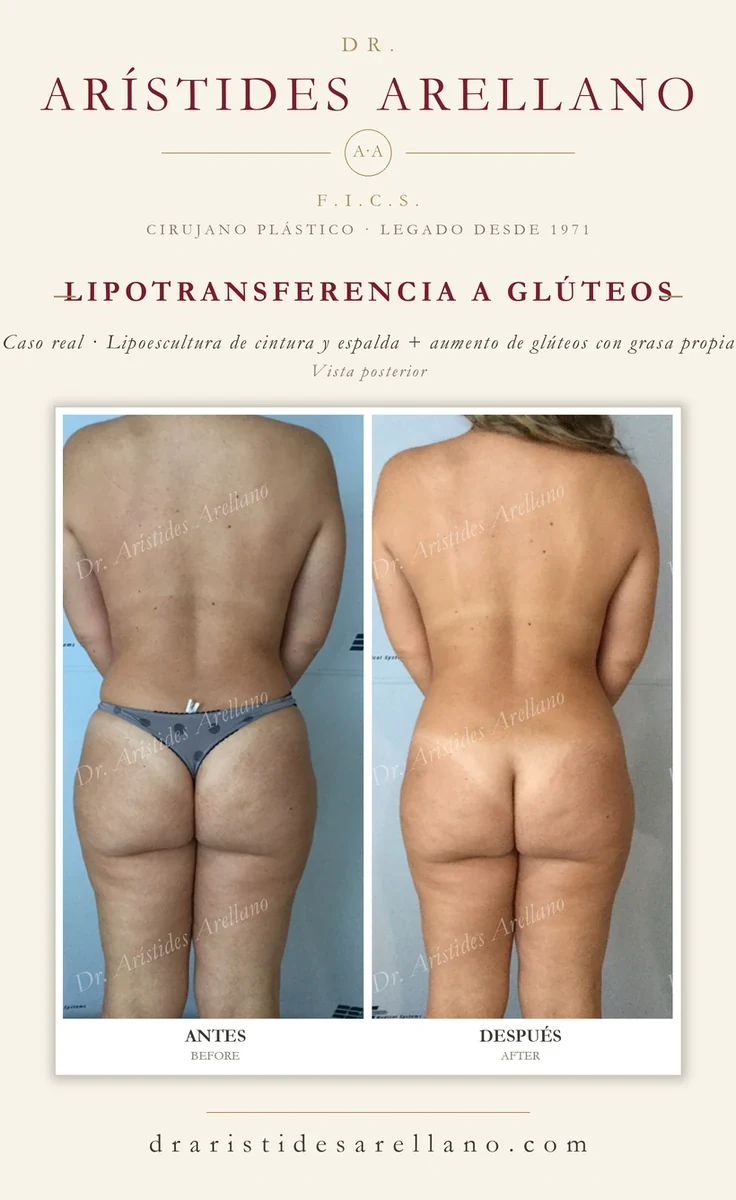 Gluteal fat transfer with waist and back liposculpture — posterior before and after, real case by Dr. Arístides Arellano in Puebla