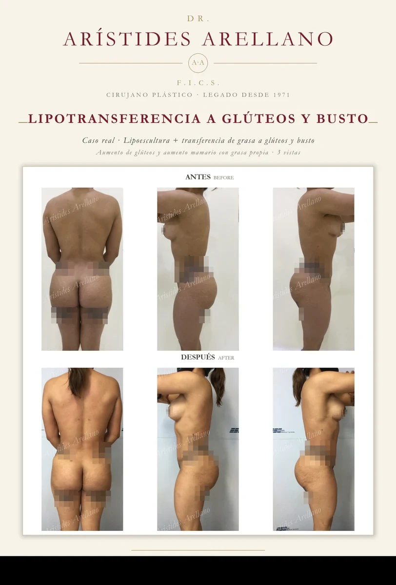 Fat transfer to buttocks and breast — before and after in 3 views: gluteal and breast augmentation with the patient's own fat, real case by Dr. Arístides Arellano in Puebla