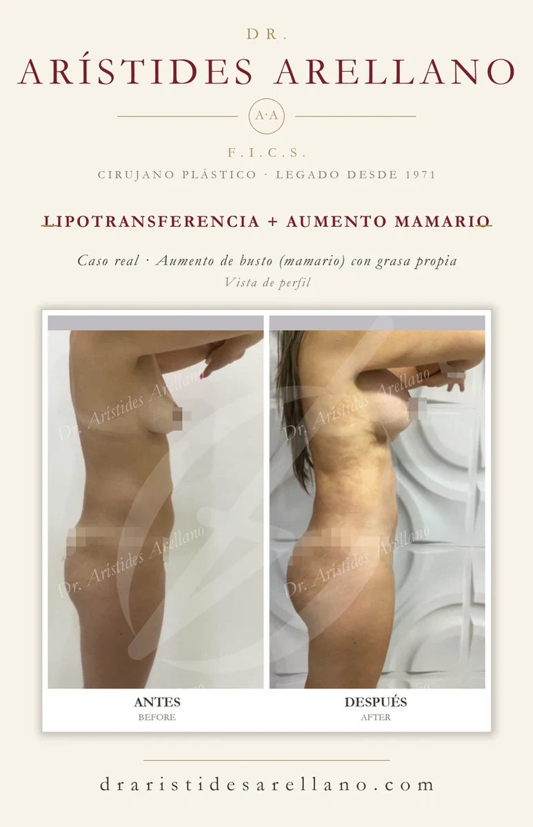Fat transfer + breast augmentation with own fat — profile before and after, real case by Dr. Arístides Arellano in Puebla