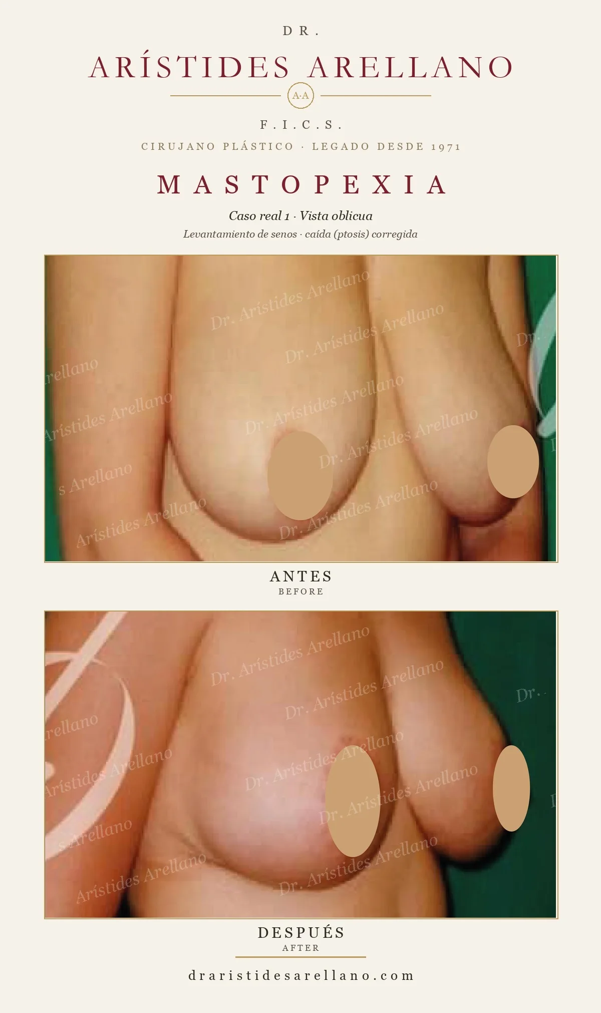 Mastopexia (levantamiento de busto) — antes y después con el Dr. Arístides Arellano