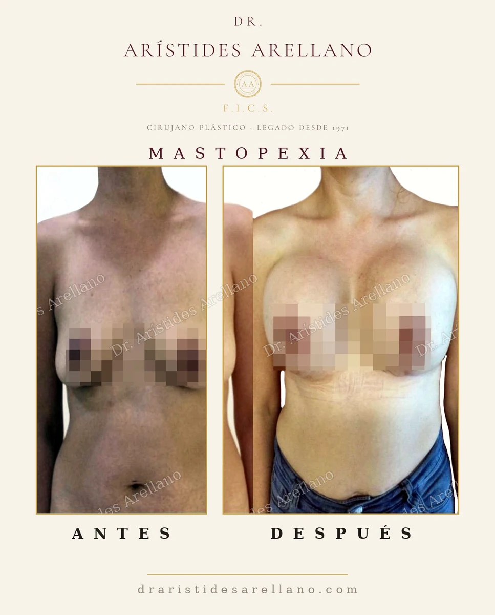 Mastopexia (levantamiento mamario): reposición del busto sin implante — antes y después, cirugía del Dr. Arístides Arellano en Puebla