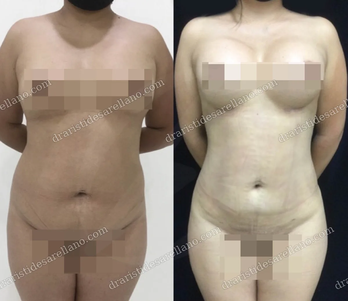 Mommy makeover — antes y después, abdomen y busto con el Dr. Arístides Arellano