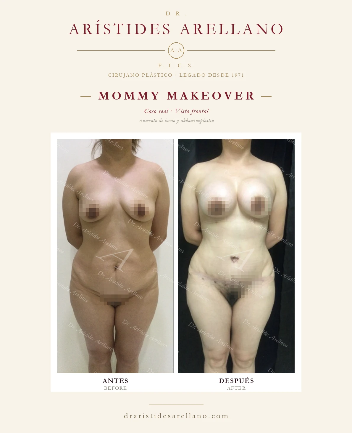 Mommy makeover en Puebla — Aumento de busto y abdominoplastia, antes y después con el Dr. Arístides Arellano