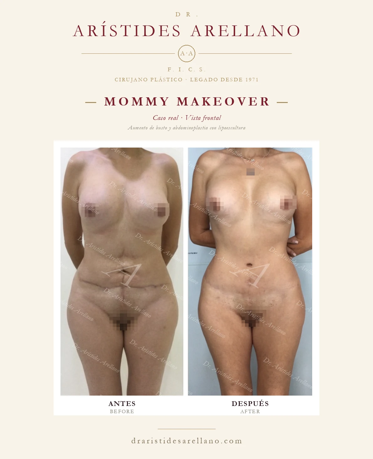Mommy makeover en Puebla — Aumento de busto y abdominoplastia con lipoescultura, antes y después con el Dr. Arístides Arellano