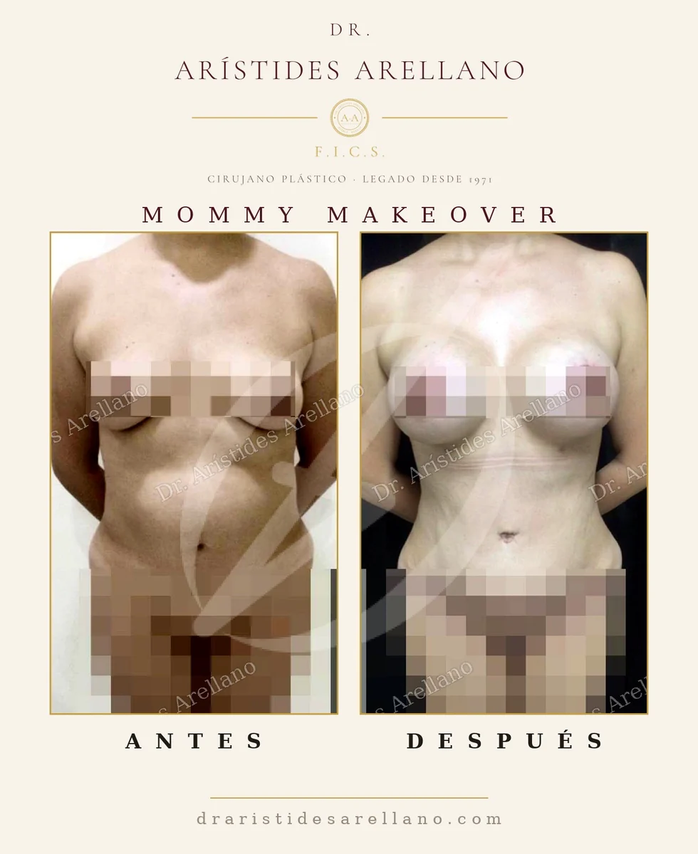 Mommy makeover antes y después de frente: abdominoplastia y aumento mamario en el mismo tiempo quirúrgico, resultado real del Dr. Arístides Arellano en Puebla
