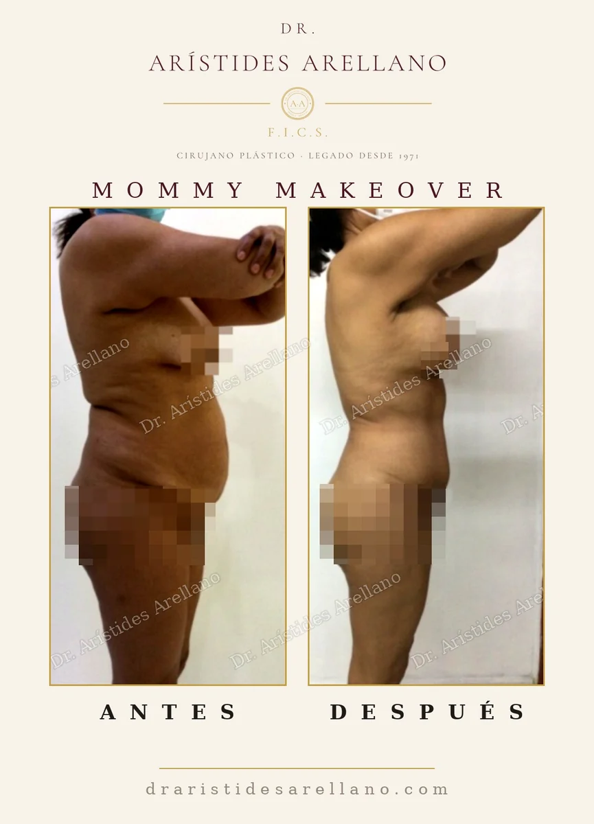 Mommy makeover antes y después de perfil: abdominoplastia con pexia mamaria, cambio de contorno completo, caso del Dr. Arístides Arellano en Puebla