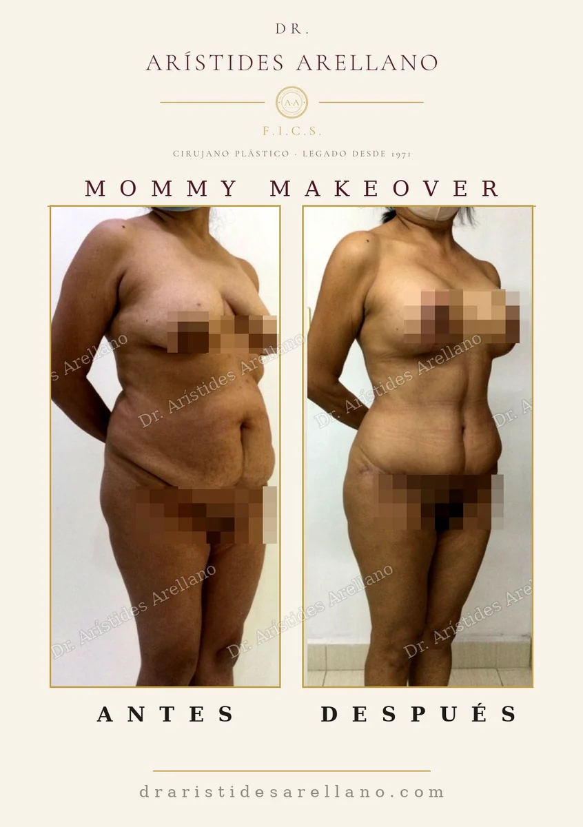 Mommy makeover antes y después en vista oblicua tras embarazo y lactancia, abdomen y senos, resultado del Dr. Arístides Arellano, cirujano plástico en Puebla