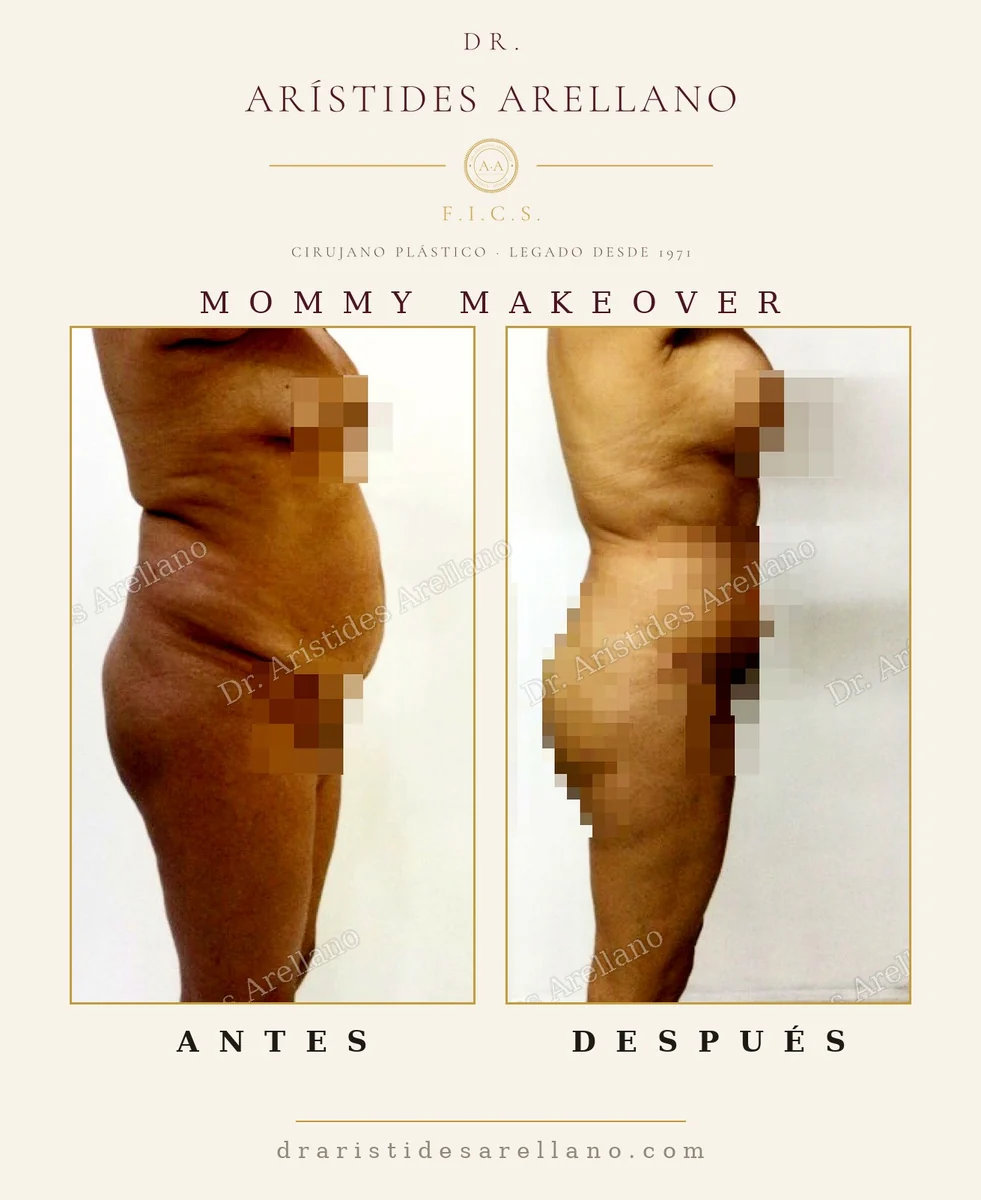Mommy makeover antes y después de perfil, recuperación y seguridad del procedimiento combinado, cirugía del Dr. Arístides Arellano en Puebla
