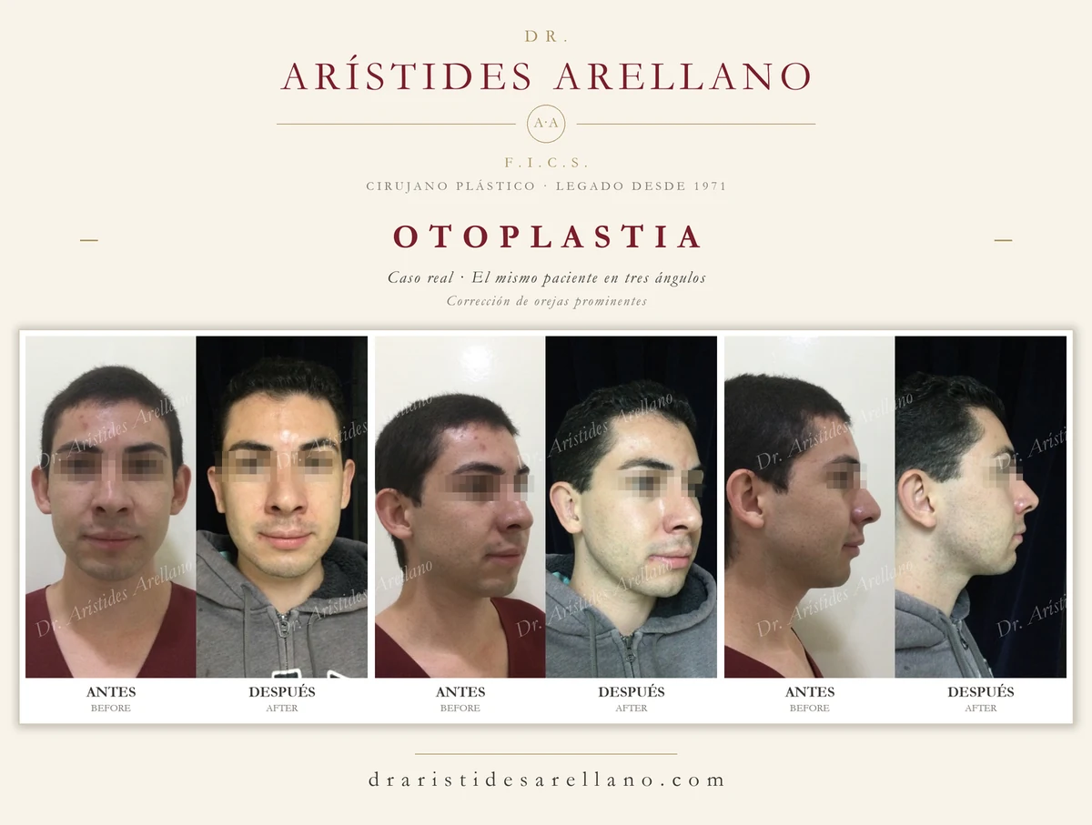 Otoplastia — antes y después del mismo paciente en tres ángulos (frontal, oblicua y perfil), corrección de orejas prominentes, caso real del Dr. Arístides Arellano en Puebla