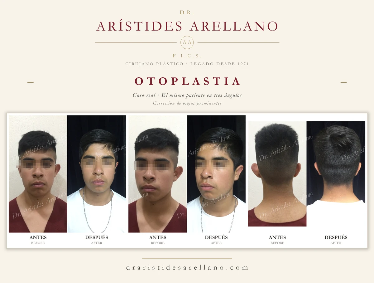 Otoplastia — antes y después del mismo paciente en tres ángulos (frontal, oblicua y posterior), corrección de orejas prominentes, caso real del Dr. Arístides Arellano en Puebla