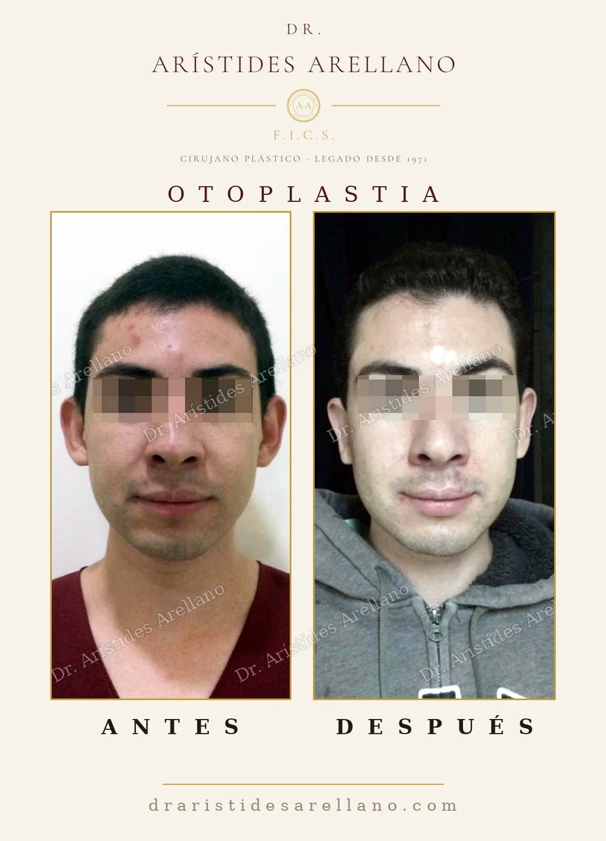 Otoplastia en hombre joven, vista frontal: orejas prominentes corregidas — antes y después, cirugía del Dr. Arístides Arellano en Puebla