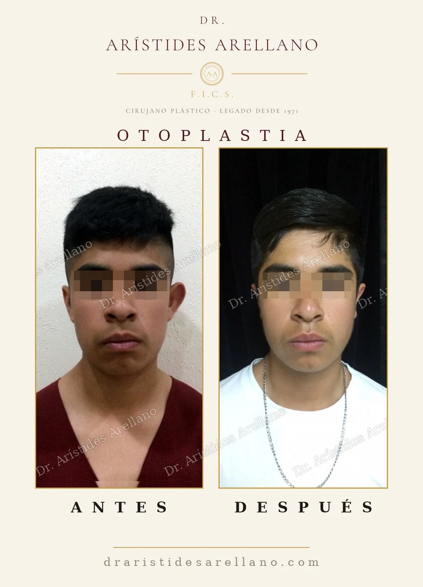 Otoplastia, segundo caso frontal: proyección de la oreja reducida de forma simétrica — antes y después con el Dr. Arístides Arellano en Puebla