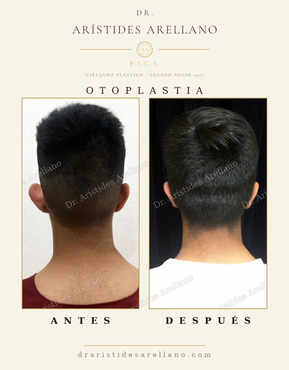 Otoplastia vista posterior: el ángulo entre la oreja y el cráneo, antes y después — cirugía del Dr. Arístides Arellano en Puebla