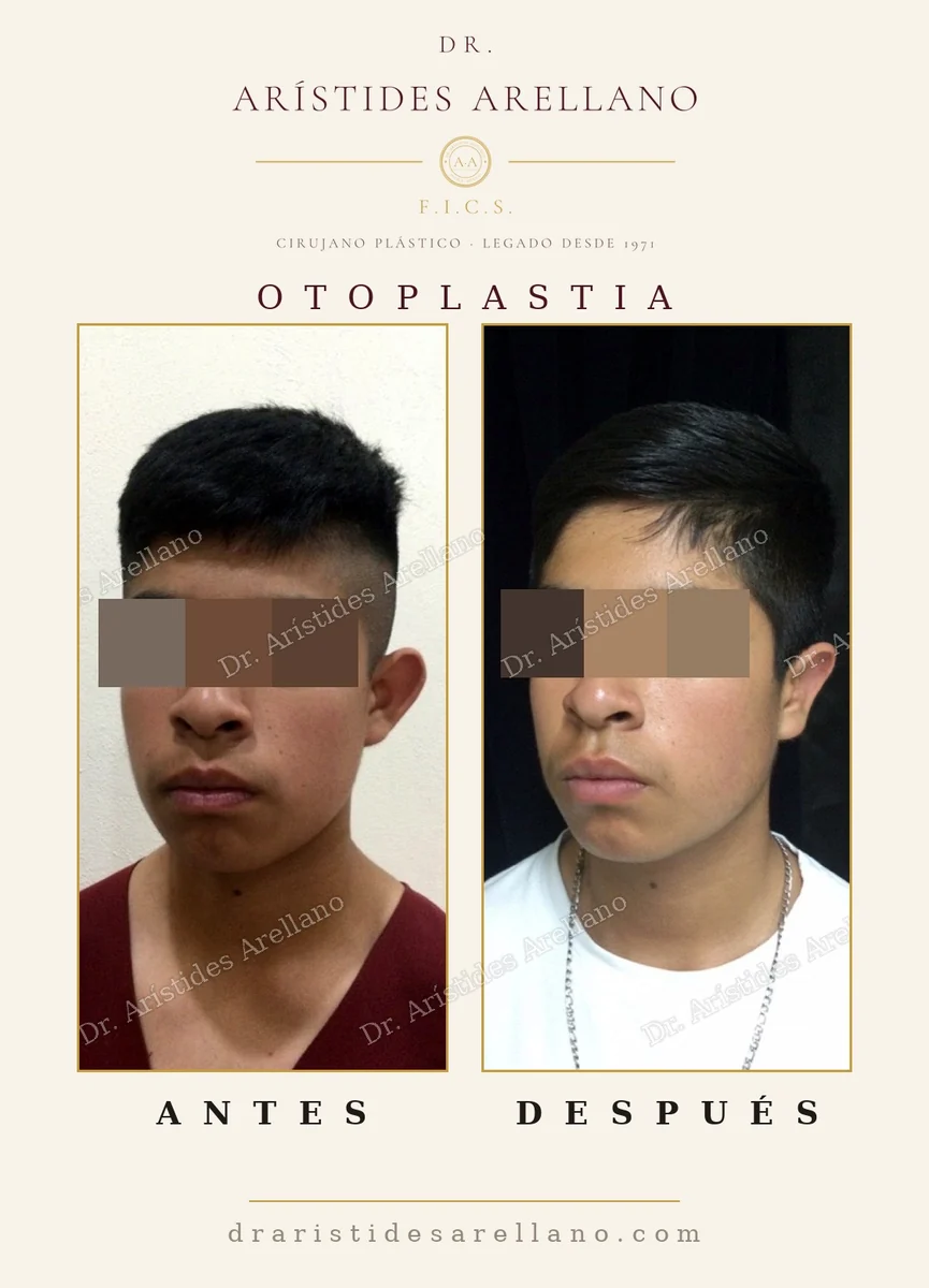 Otoplastia antes y después en vista frontal, corrección de orejas prominentes o de soplillo en paciente joven, cirugía del Dr. Arístides Arellano, cirujano plástico en Puebla