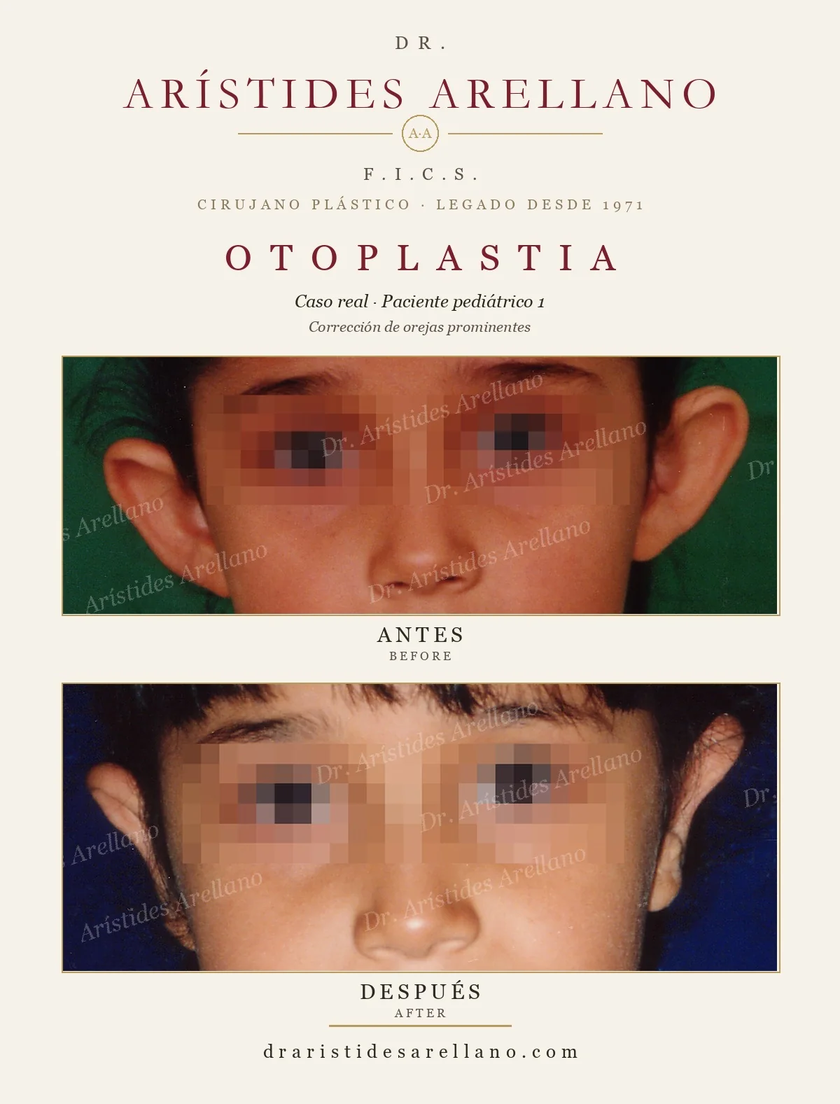 Otoplastia infantil antes y después en vista frontal (paciente pediátrico, identidad protegida con pixelado), corrección de orejas prominentes o de soplillo en niños, caso real del Dr. Arístides Arellano, cirujano plástico en Puebla