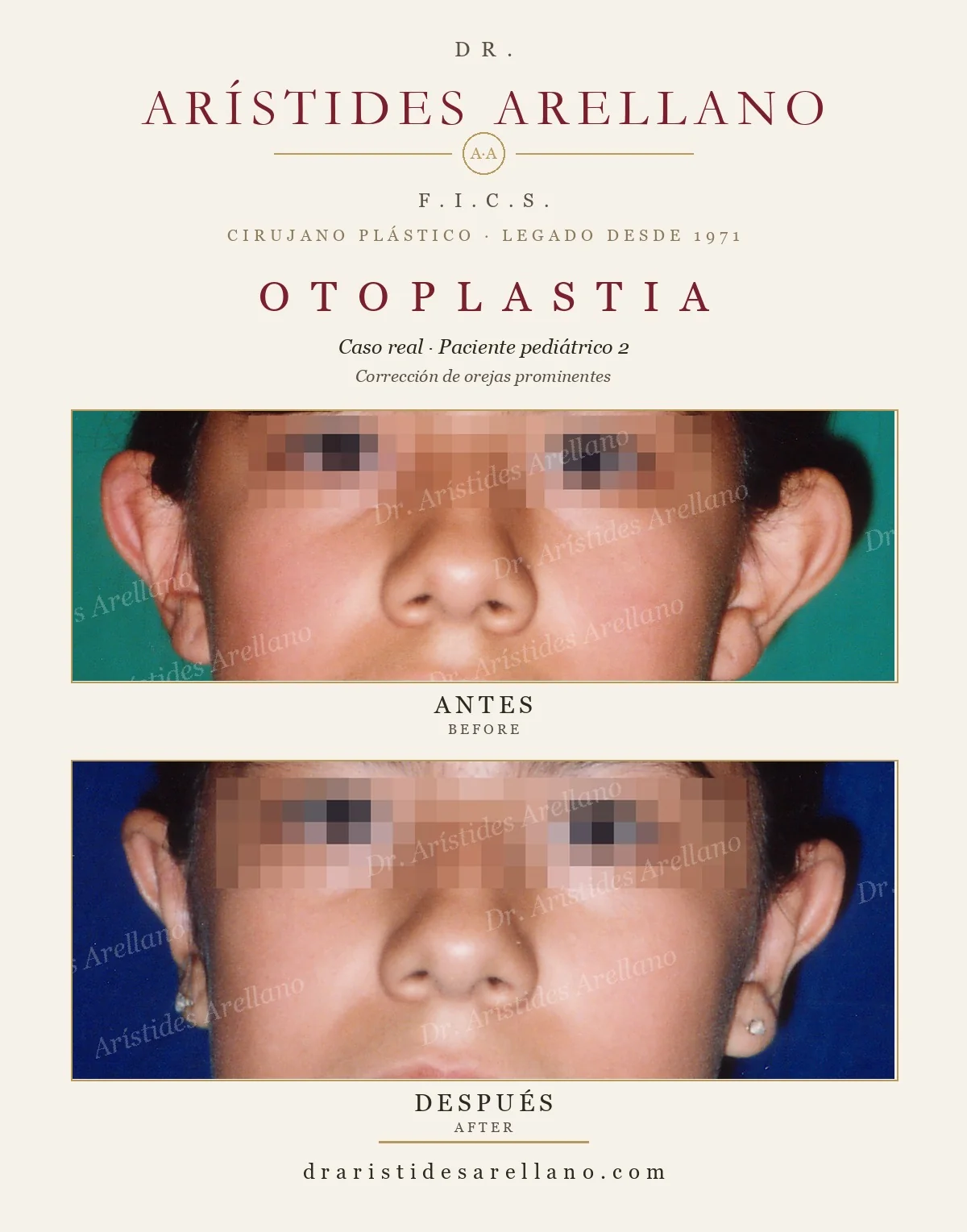 Otoplastia infantil antes y después en vista frontal (segundo paciente pediátrico, identidad protegida con pixelado), corrección de orejas prominentes o de soplillo en niños, caso real del Dr. Arístides Arellano, cirujano plástico en Puebla