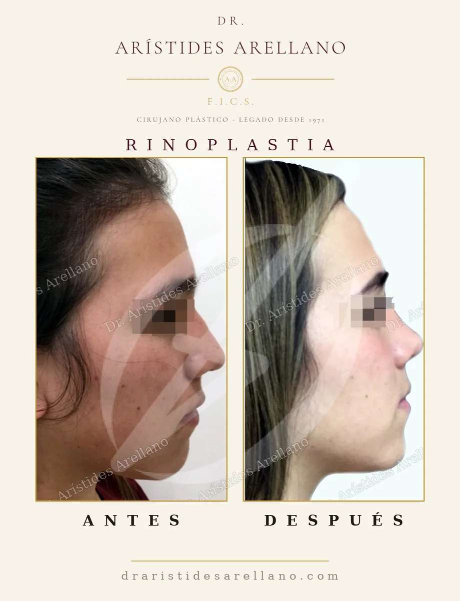 Rinoplastia — antes y después (segundo caso), cirugía nasal con el Dr. Arístides Arellano, cirujano plástico en Puebla