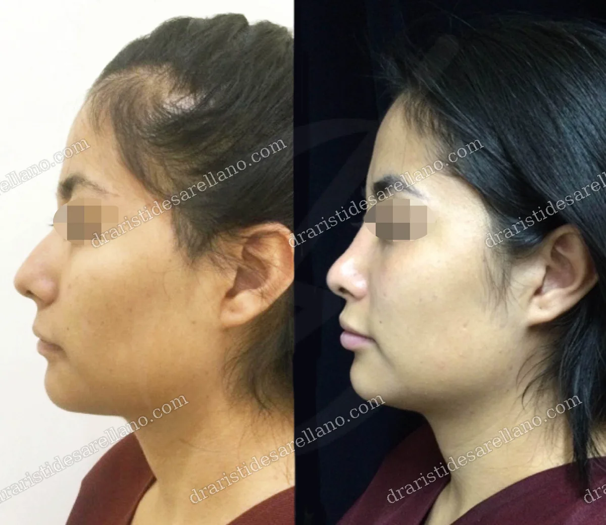 Rinoplastia — antes y después de cirugía nasal con el Dr. Arístides Arellano