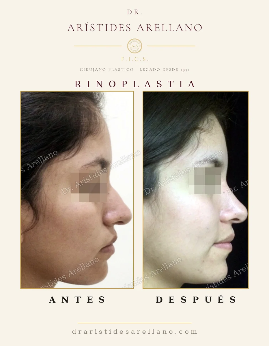 Rinoplastia — antes y después (tercer caso), cirugía de nariz con el Dr. Arístides Arellano en Puebla