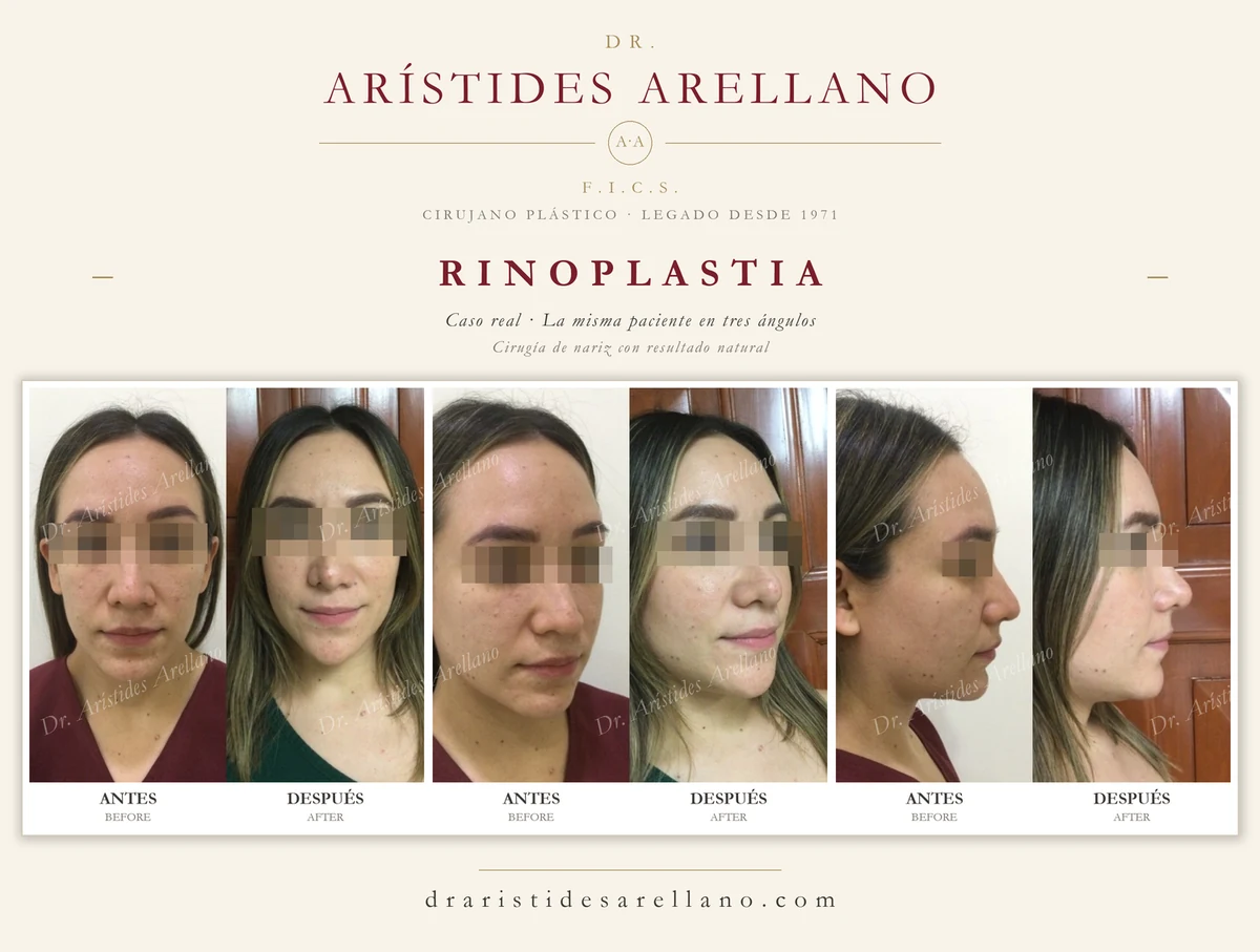 Rinoplastia — antes y después de la misma paciente en tres ángulos (frontal, oblicua y perfil), cirugía de nariz con resultado natural, caso real del Dr. Arístides Arellano en Puebla