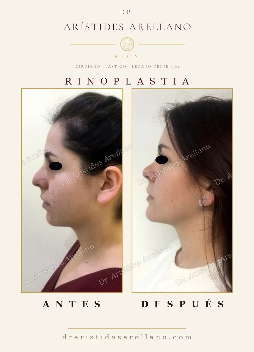 Rinoplastia y mentoplastia antes y después de perfil, cambio del ángulo nasofrontal y proyección del mentón, caso real del Dr. Arístides Arellano, cirujano plástico en Puebla