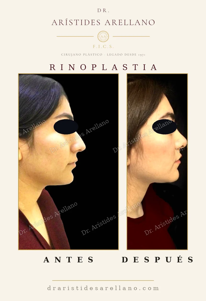 Rinoplastia antes y después de perfil, corrección del dorso nasal y de la punta, cirugía del Dr. Arístides Arellano en Puebla