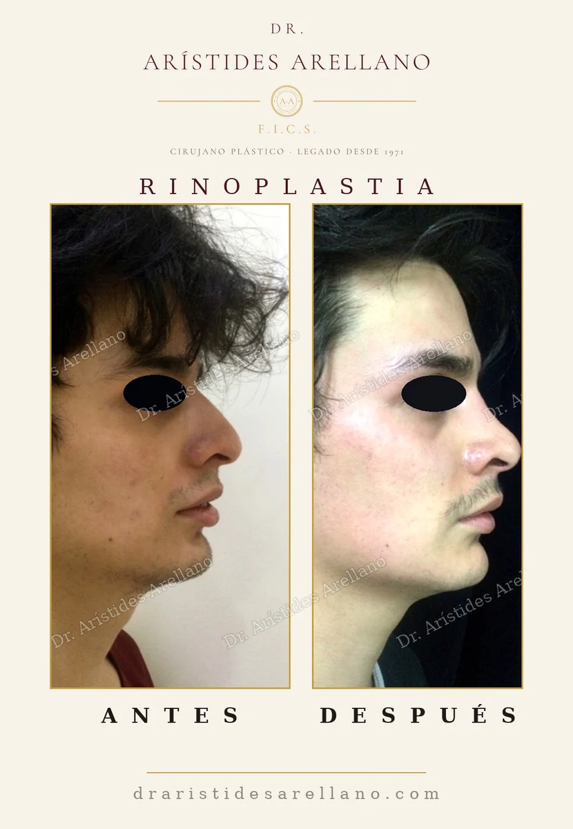 Rinoplastia en hombre antes y después de perfil, reducción de la giba nasal conservando el carácter masculino, resultado del Dr. Arístides Arellano en Puebla