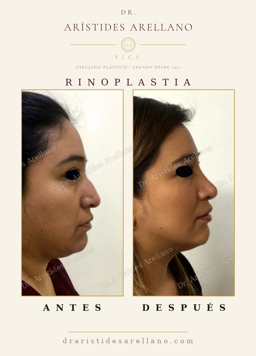 Rinoplastia antes y después de perfil, resultado definitivo tras la resolución de la inflamación, caso del Dr. Arístides Arellano, cirujano plástico en Puebla