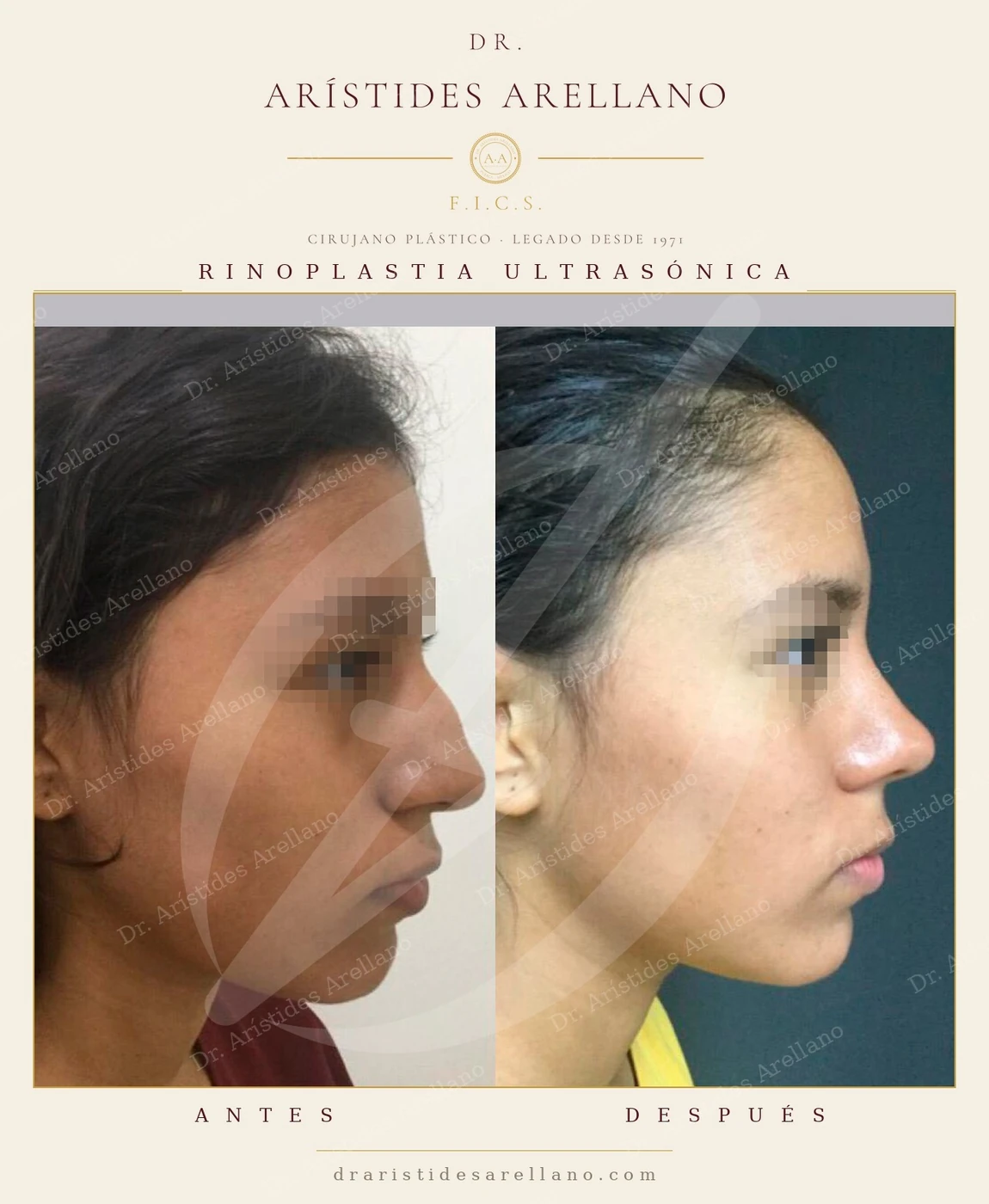 Rinoplastia ultrasónica en Puebla — antes y después de perfil: dorso nasal alisado y punta nasal refinada, conservando la proporción con el resto del rostro. Cirugía realizada por el Dr. Arístides Arellano, cirujano plástico con cédula de especialidad 0002008. Los resultados pueden variar de una persona a otra.