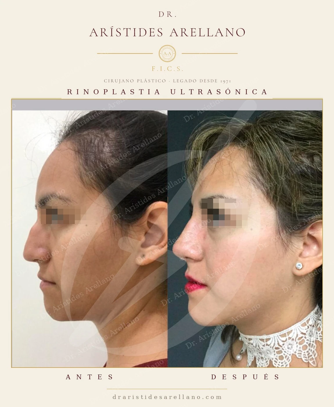 Rinoplastia ultrasónica en Puebla — antes y después de perfil en paciente adulta: proyección de la punta nasal y perfil armonizado con el mentón, sin borrar los rasgos propios. Cirugía del Dr. Arístides Arellano, cirujano plástico, F.I.C.S. Los resultados pueden variar de una persona a otra.