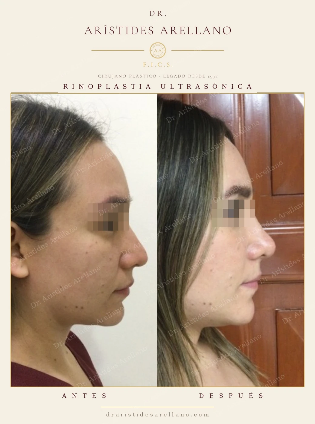 Rinoplastia ultrasónica de definición (HD) en Puebla — perfil antes y después: giba nasal corregida y ángulo nasolabial equilibrado. La técnica ultrasónica trabaja el hueso con vibración en lugar de fractura, lo que permite un contorno más preciso. Dr. Arístides Arellano, cirujano plástico en Puebla. Los resultados pueden variar.