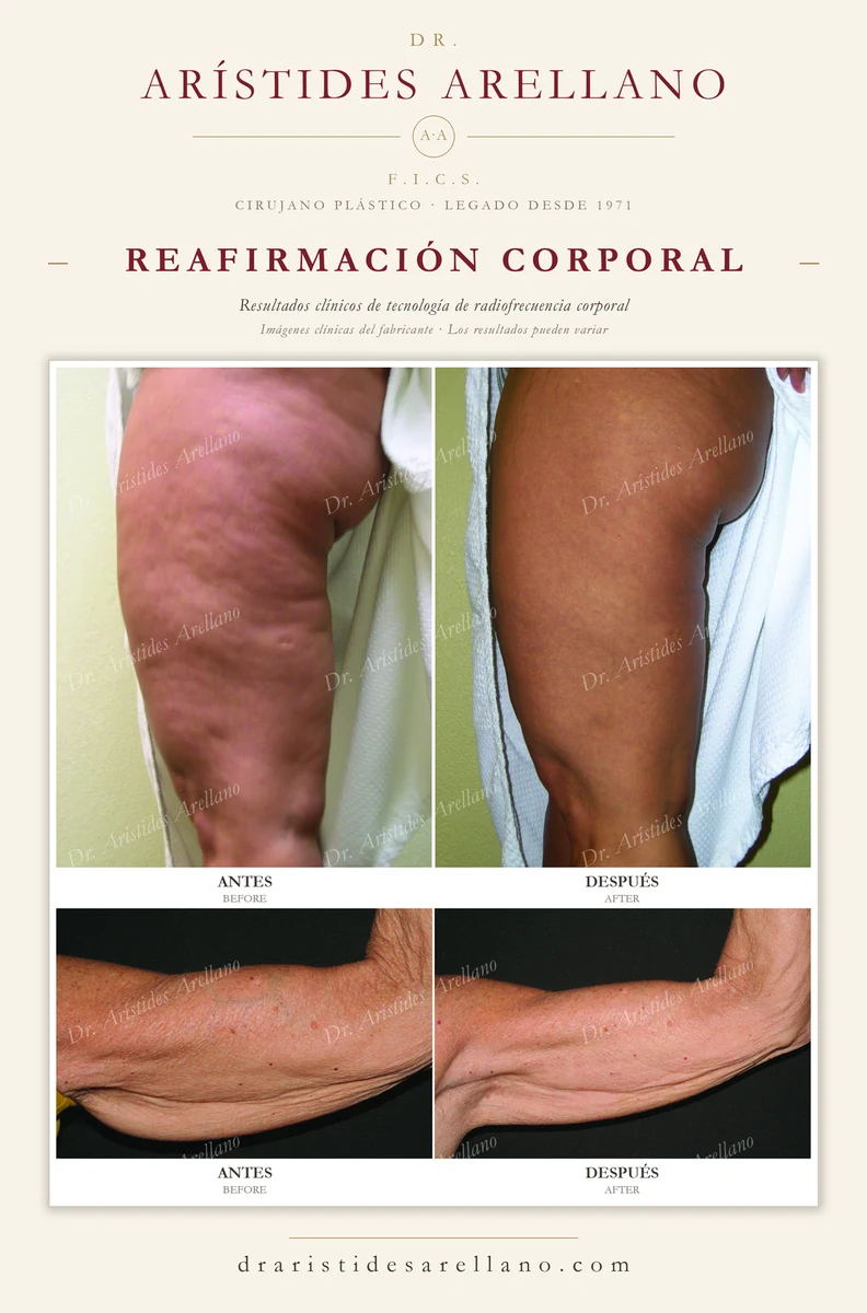 Reafirmación corporal — resultados clínicos de tecnología de radiofrecuencia corporal en muslos y brazos (imágenes clínicas del fabricante)